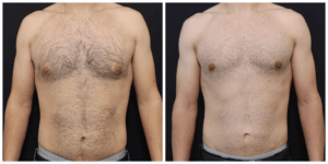 Mens Gynecomastia Surgery