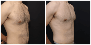 Top Plastic Surgery Procedures For Men Top Plastic Surgery Procedures For Men