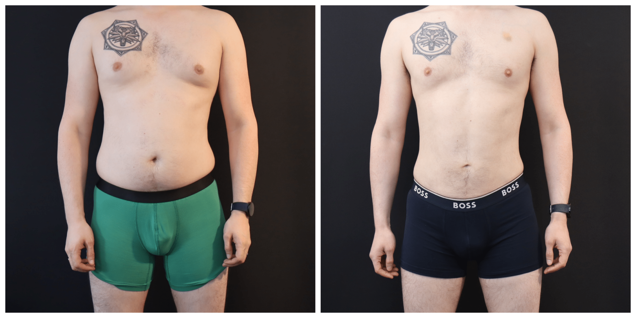 Liposuction for Men San Francisco