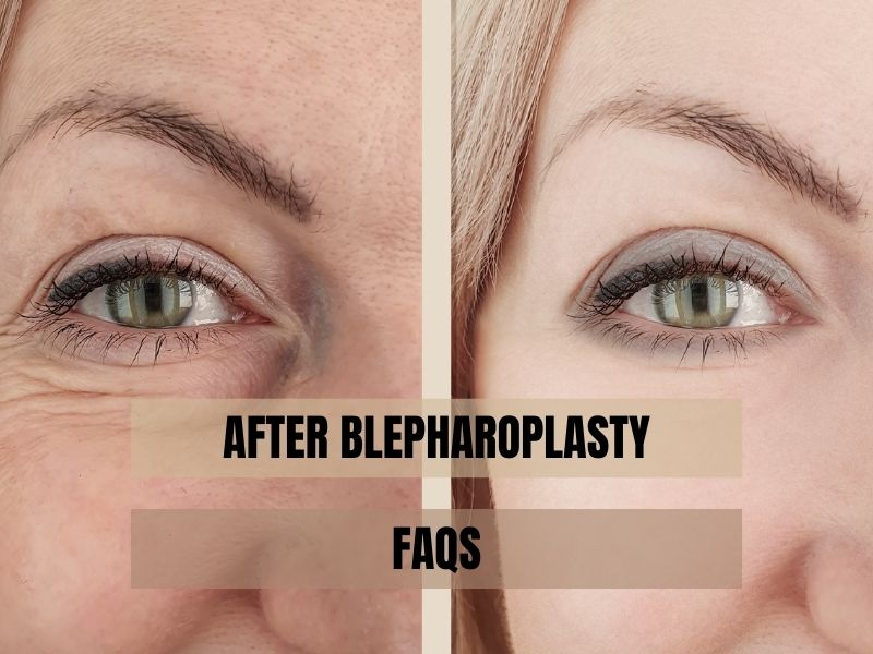 After Blepharoplasty FAQs