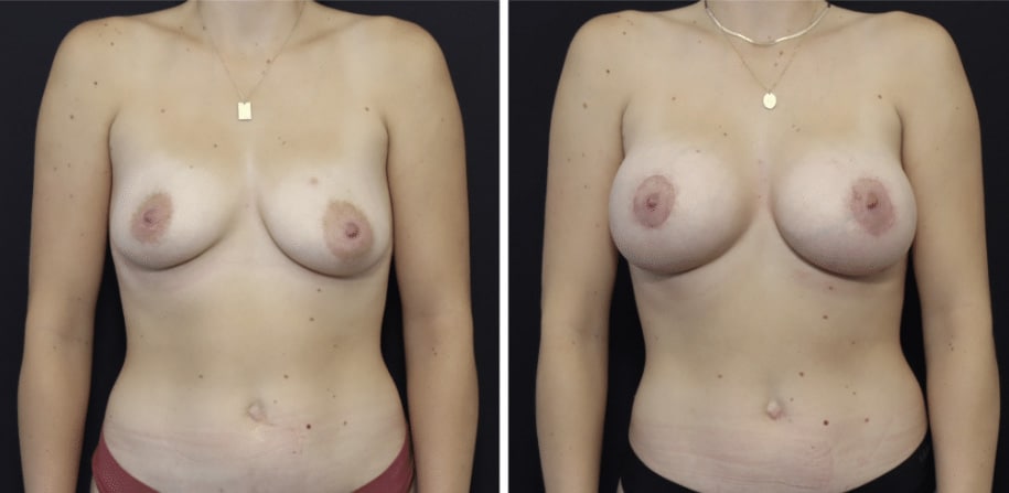 Asymmetry breast surgery San Francisco