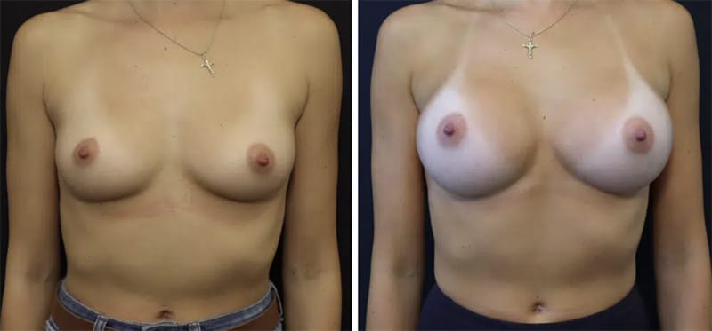 Bay Area Breast Augmentation
