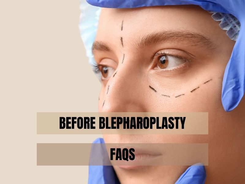 Before Blepharoplasty
