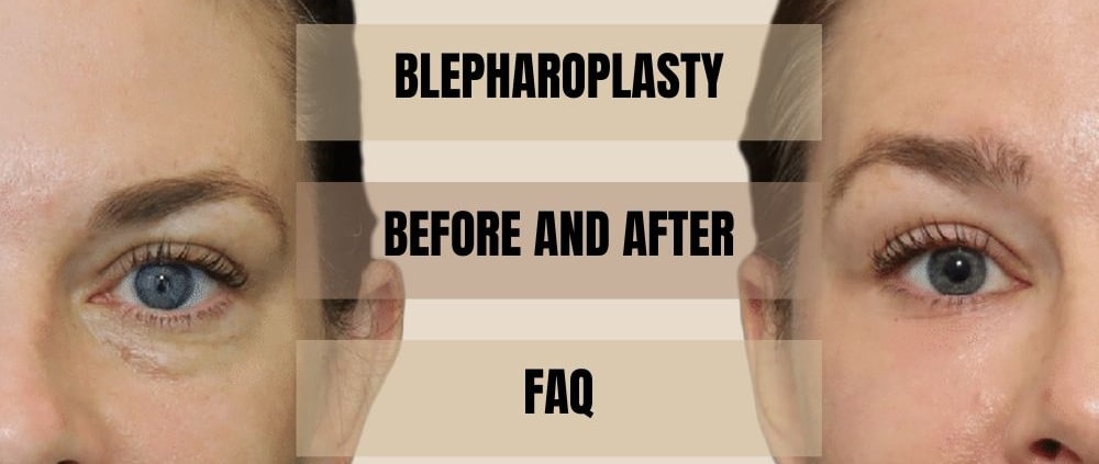 Blepharoplasty Before and After FAQs
