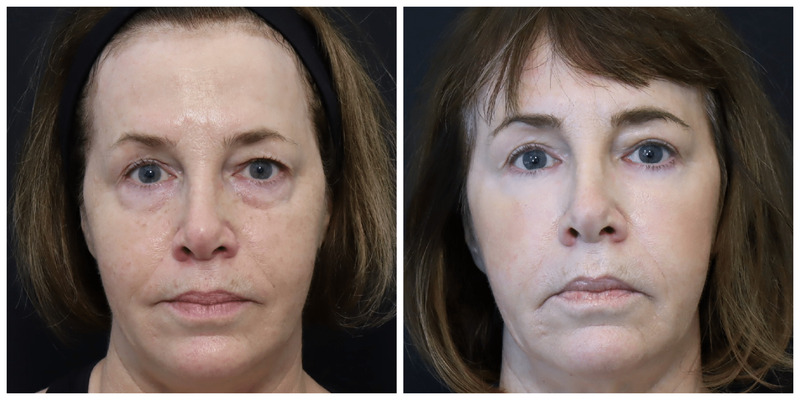 Blepharoplasty Before and After Photos San Francisco