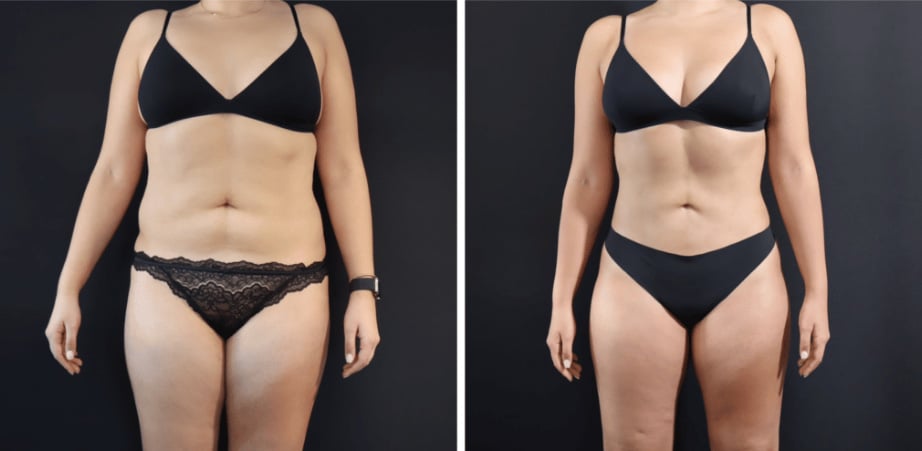 Body Contouring in San Francisco Bay Area