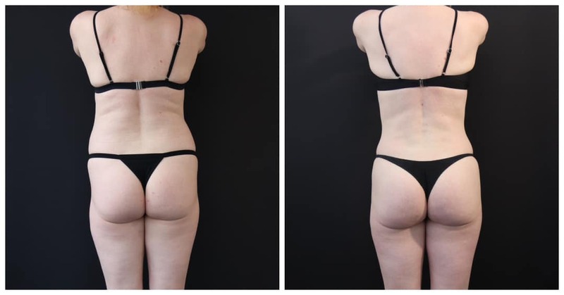 Brazilian Butt Lift San Francisco Bay Area Before After