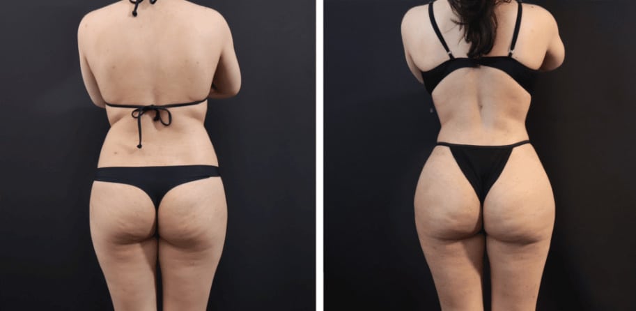 Brazilian Butt Lift (BBL) - High Valley Dermatology