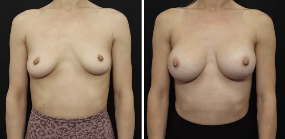 Breast Asymmetry Cost