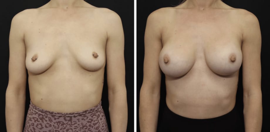 Breast Asymmetry