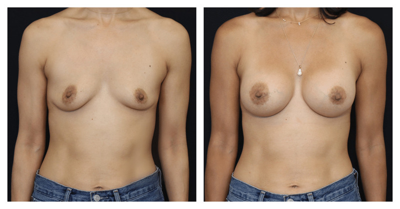 Breast Augmentation Before and After San Francisco