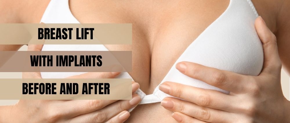 Breast Lift With Implants Before and After