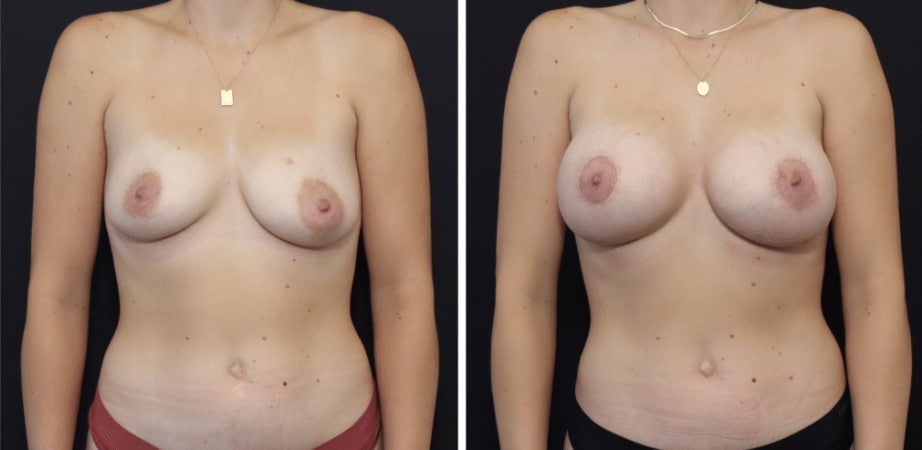 Breast Lift with Implants San Francisco Bay Area