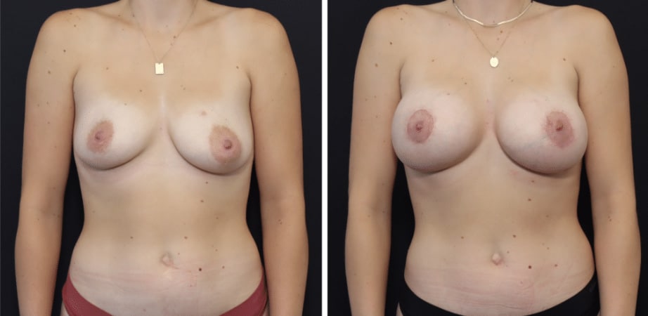 Breast Lift with Implants San Francisco Bay Area
