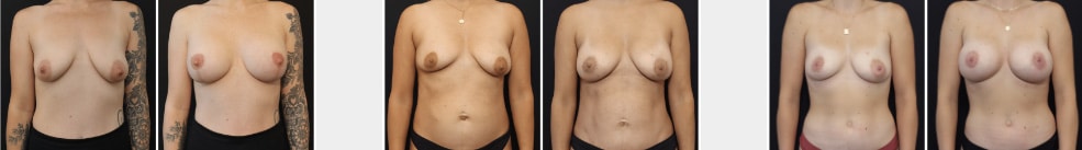 Breast Lift with Implants in San Francisco