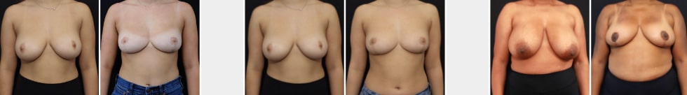 Breast Reduction in San Francisco