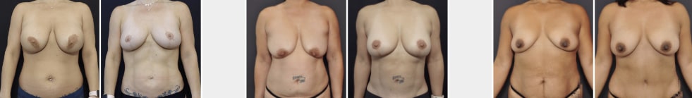 Breast fat Transfer in San Francisco