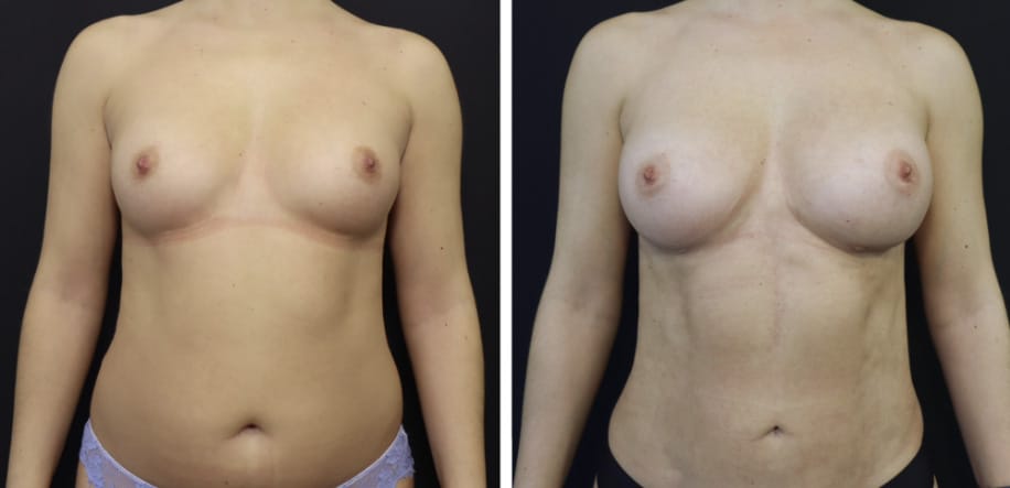 Breast fat transfer 1 year later