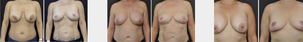 Breast implant removal San Francisco