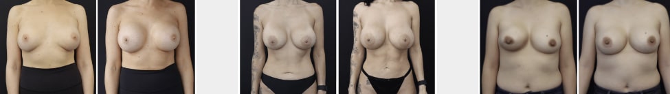 Breast implant revision San Francisco