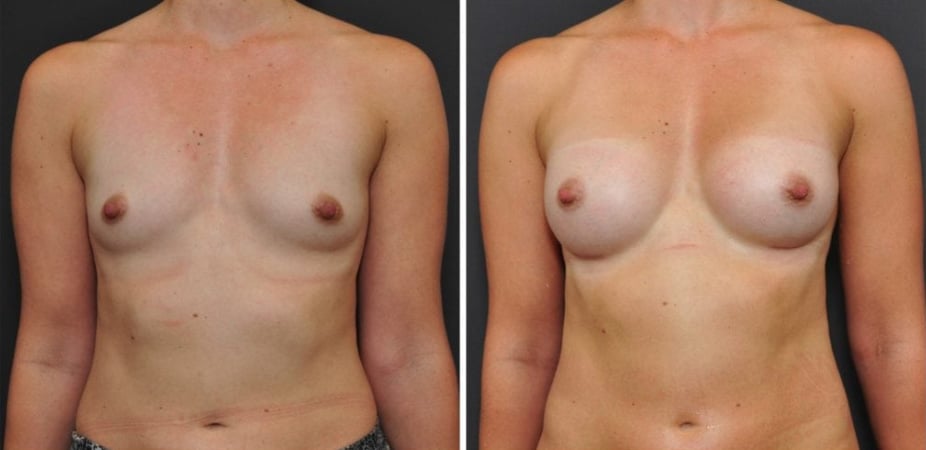 Composite Breast Augmentation San Francisco