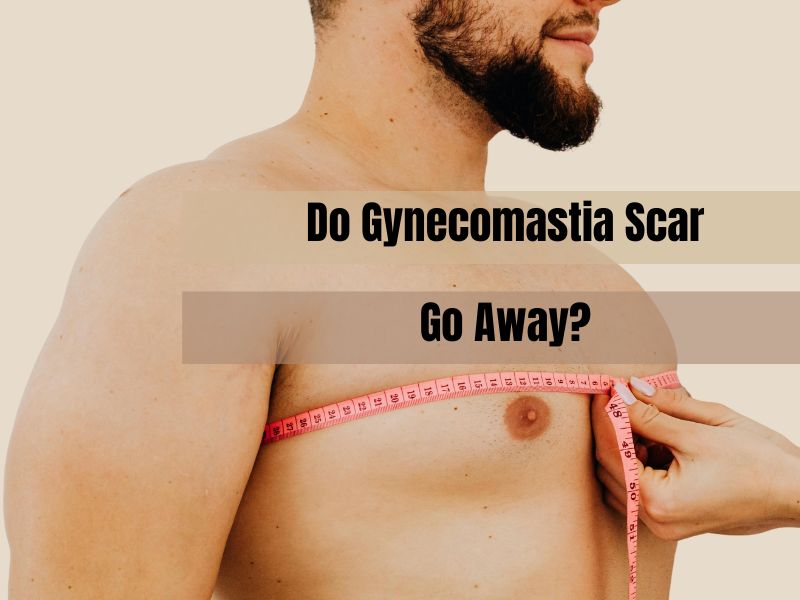 Do Gynecomastia Scar Go Away