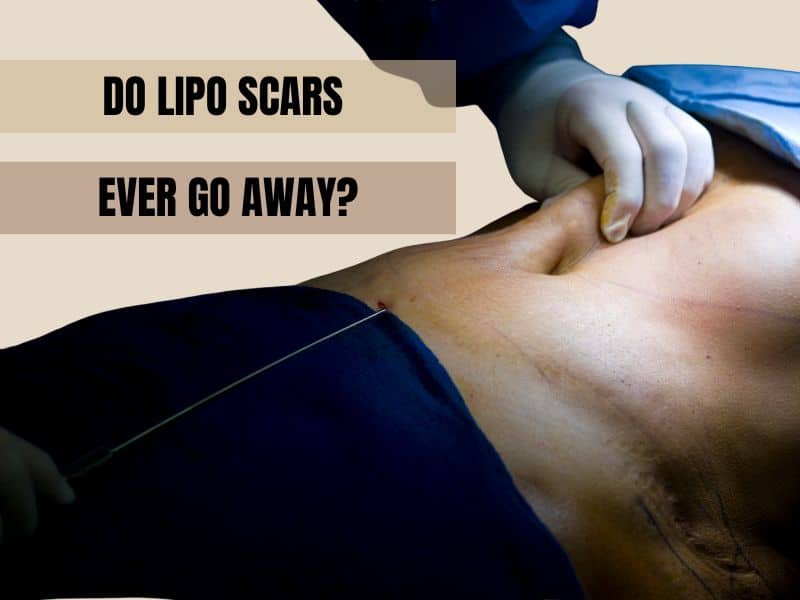 Do lipo scars ever go away