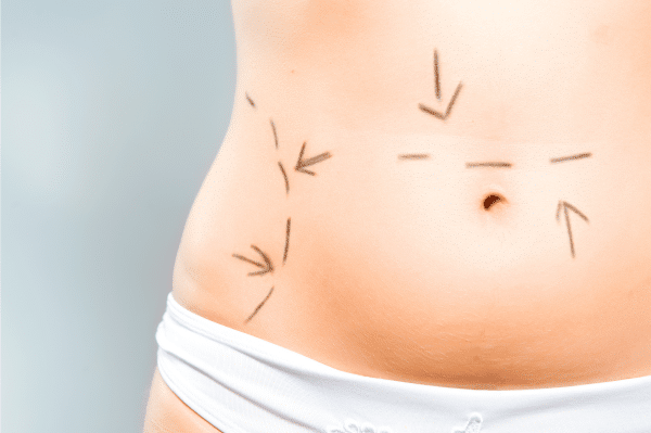 Does SmartLipo Or Vaser Lipo Cause More Scar