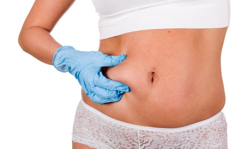 Does fat come back after liposuction