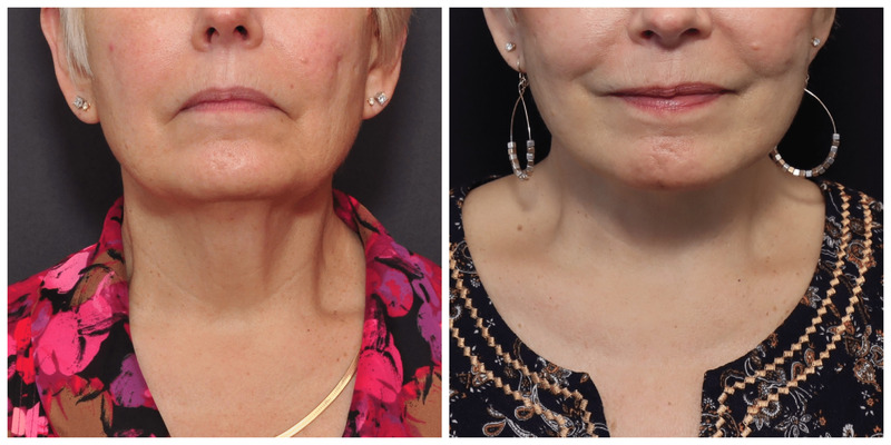 Facelift in San Francisco before After