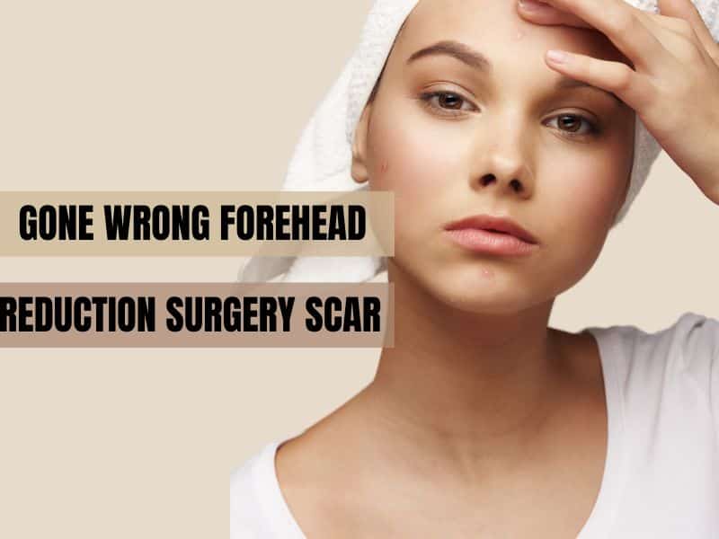 Gone Wrong Forehead Reduction Surgery Scar