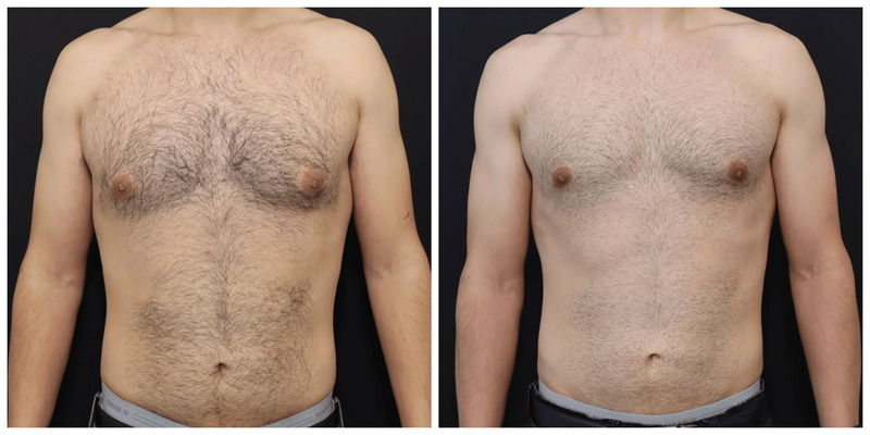 Gynecomastia San Francisco Before After
