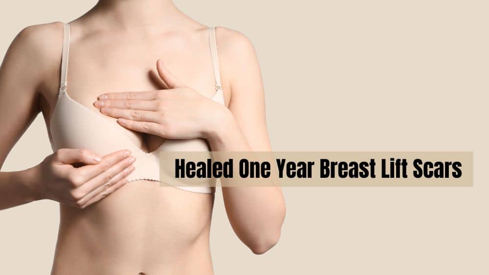 Healed One Year Breast Lift Scars - Sieber
