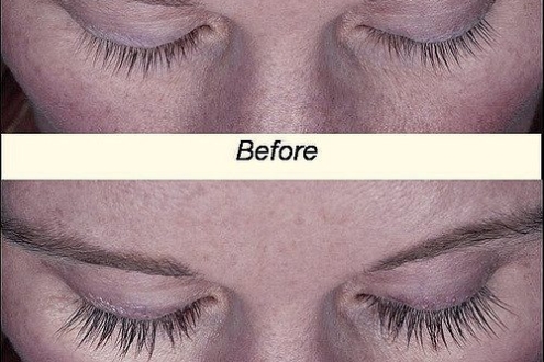 LATISSE Eyelash Treatment San Francisco