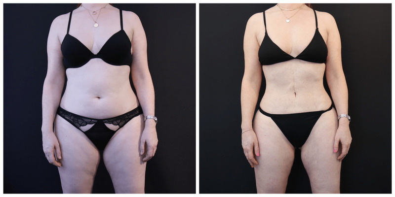 Liposuction San Francisco Before After