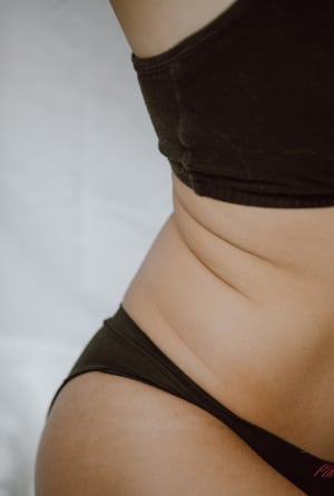 Liposuction and tummy tuck