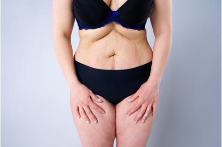 Liposuction with tummy tuck