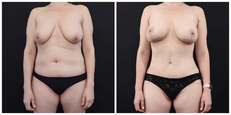 Mommy Makeover San Francisco Before and After