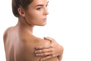 Plastic Surgery Scars
