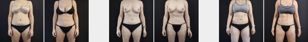 Renuvion J/Plasma Before and Afters SF
