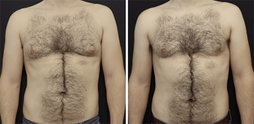 Rid man boobs before and after