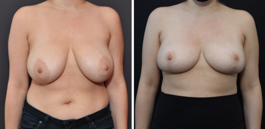 San Francisco Bay Area Breast Reduction