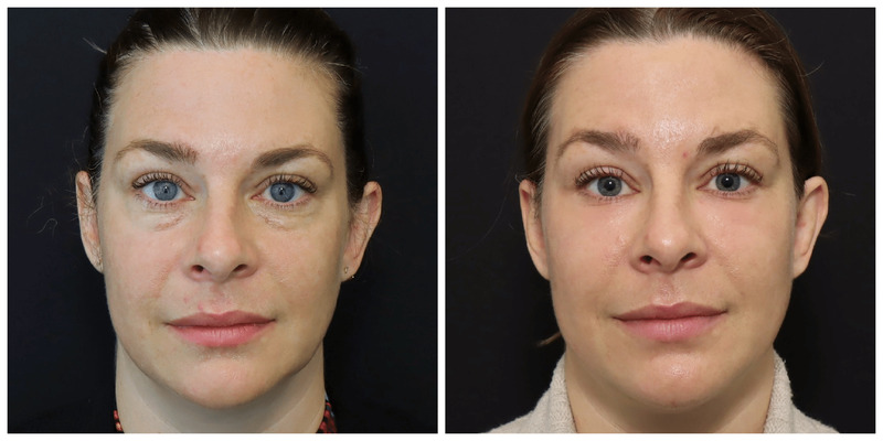 San Francisco Blepharoplasty Before and After Photos