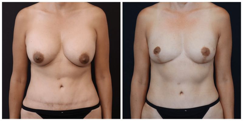 San Francisco Breast Implant Removal Before and After