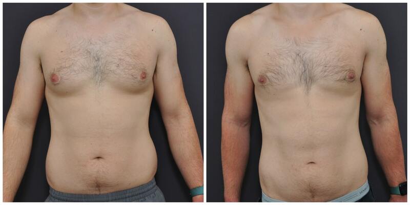 San Francisco Gynecomastia Before After