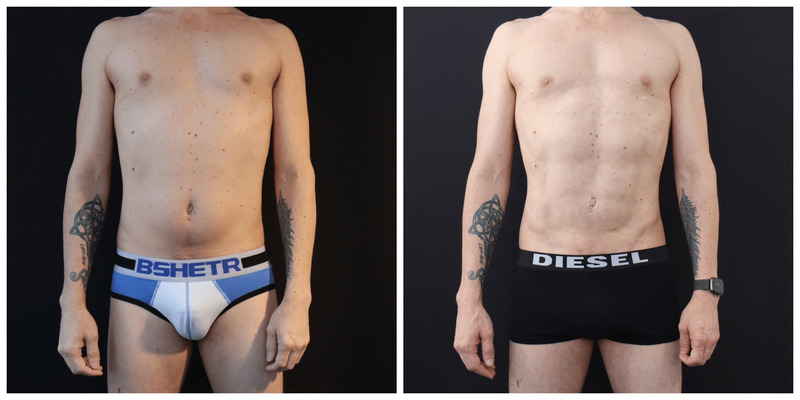 San Francisco liposuction for men Before After