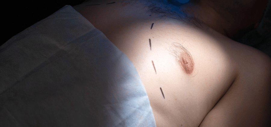 Should You Worry About A Gynecomastia Scar