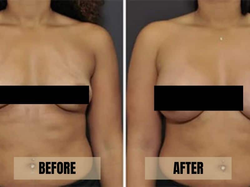 Teardrop Implant Before And After Pictures