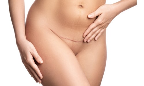 Tummy Tuck the worst days