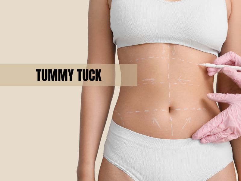 Tummy Tuck